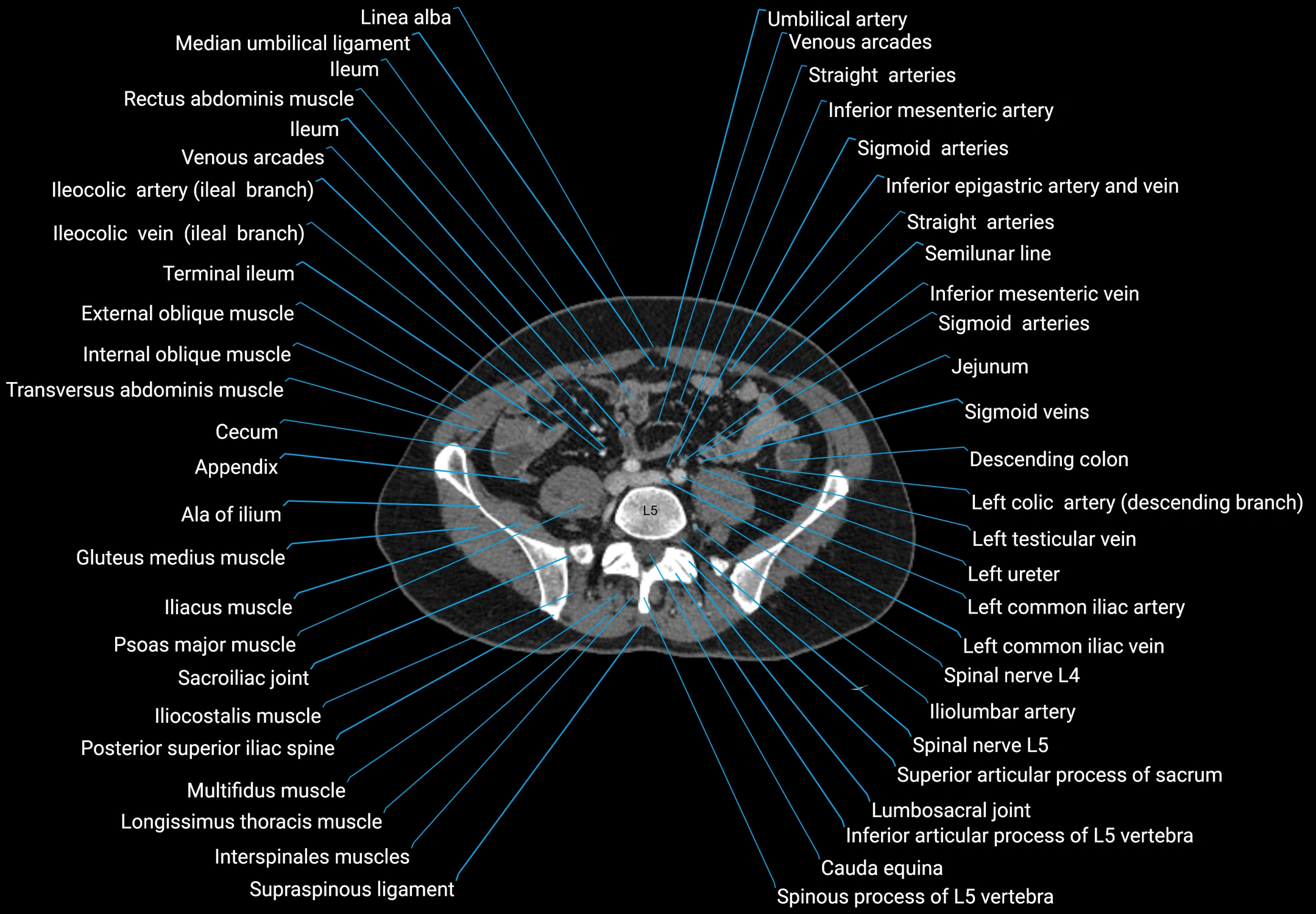 CT male pelvis axial cross sectional anatomy labelled radiology image -00129.webp